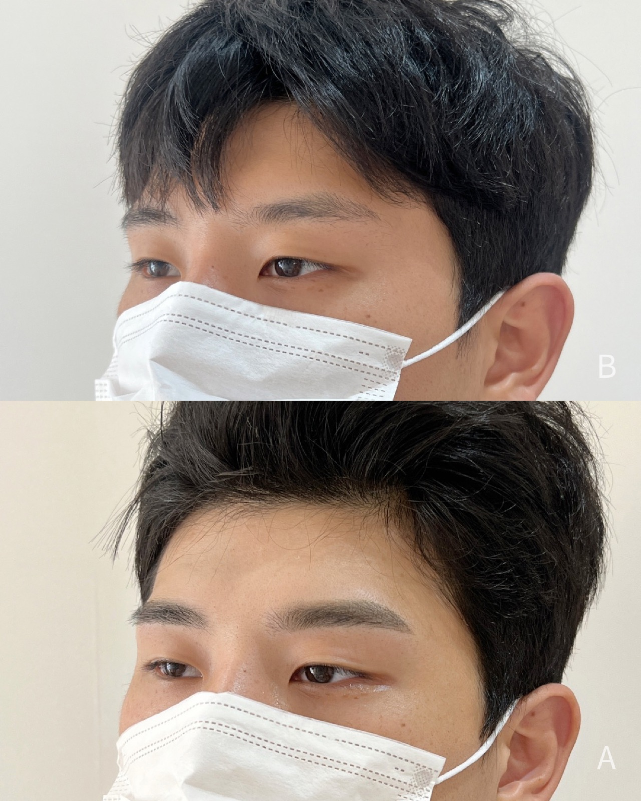 남성 콤보 눈썹 측면 전후 비교